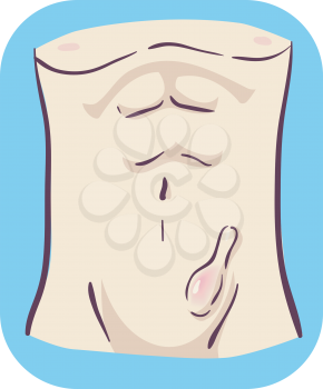 Illustration of an Inguinal Hernia