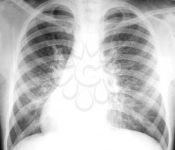 Chest X-ray image