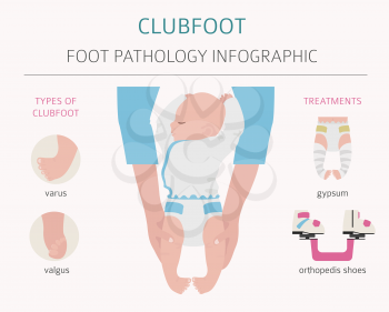 Foot deformation, medical desease infographic. Clubfoot defect. Vector illustration