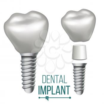 Dental Implant Vector. Implant Structure. Crown, Abutment, Screw Realistic Isolated Illustration