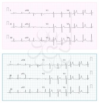 Heart Cardiogram Chart Vector. Set Healthy Heart Rhythm, Ischemia, Infarction. Vitality Heartbeat, Heart Electrocardiogram, Pulse