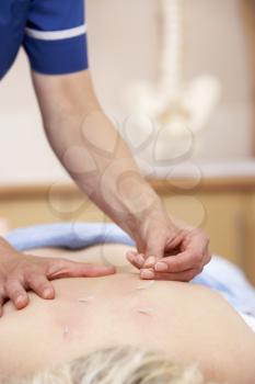 Royalty Free Photo of an Acupuncturist