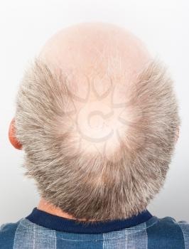 Hair loss. Bald man