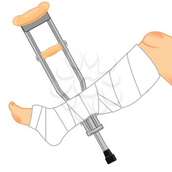 Broken leg in gypsum and crutches.Vector illustration