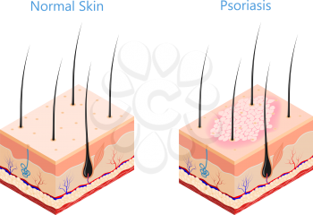 Cut human skin in isometric style on a white background isolated  Medicine problem skin psoriasis Vector illustration of psoriasis disease and healthy skin poster for the study of medical subjects