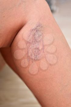 Varicose veins on female legs in the area of the knee and calves. Close-up