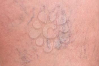 Varicose veins on female legs in the hips.