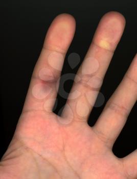 bursted capillary blood vessel in hand finger following minor injury