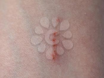 scratch scar on human arm caused by minor injury