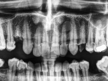 X ray of human mouth with teeth bones in black and white
