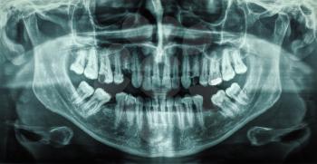 X ray of human mouth with teeth bones
