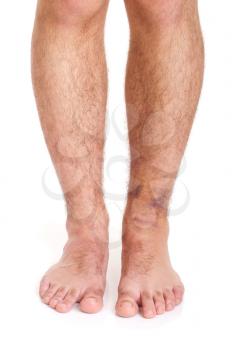 Royalty Free Photo of a Sprained Ankle