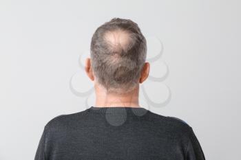 Senior man with hair loss problem on light background�
