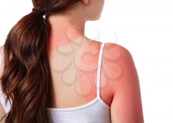 Woman with red sunburned skin against white background�