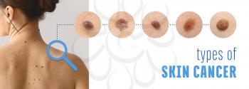 Young woman with different types of moles. Concept of skin cancer�