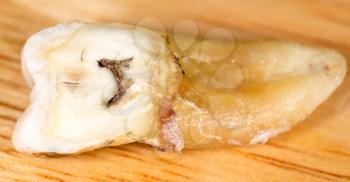 caries in the tooth. macro