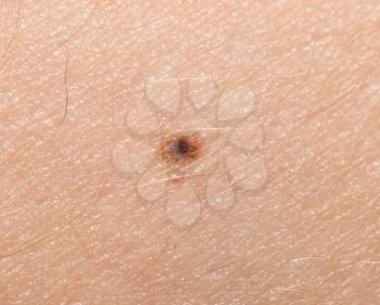 mole on the human skin