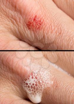 wound on the human skin. macro