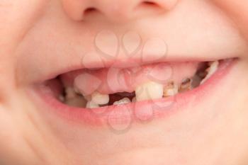 teeth in children. close-up
