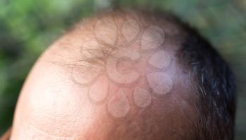 hair loss on the head of a man