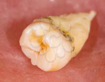 A tooth torn by a doctor in dentistry
