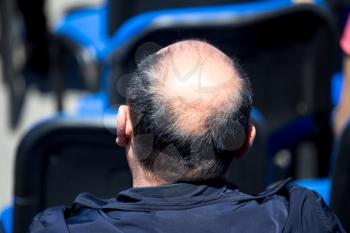 Big bald patch on a man's head .