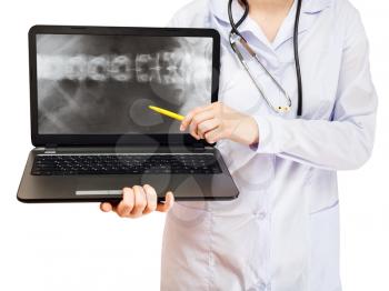 nurse points on computer laptop with X-ray picture of human spinal column on screen isolated on white background