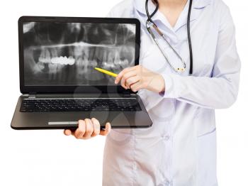 nurse points on computer laptop with X-ray picture of human jaw on screen isolated on white background