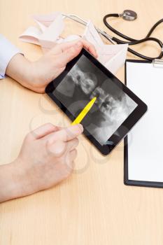 doctor examines X-ray picture of human spinal column on tablet pc