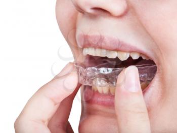 girl fixes clear aligner for orthodontic correction of bite isolated on white background