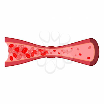 Blood clot in vein isolated. Blood vessel disease on white background. anatomical illustration
