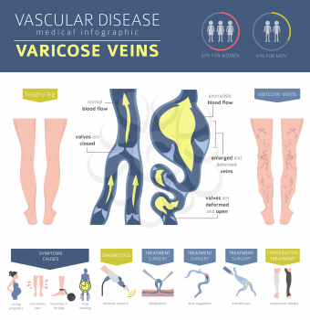 Vascular diseases. Varicose veins symptoms, treatment icon set. Medical infographic design. Vector illustration