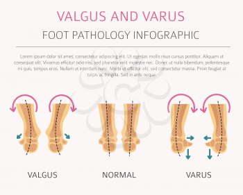 Foot deformation as medical desease infographic. Valgus and varus defect. Vector illustration