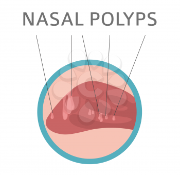 Nasal diseases. Nasal polyps causes, diagnosis and treatment medical infographic design. Vector illustration
