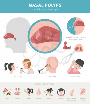 Nasal diseases. Nasal polyps causes, diagnosis and treatment medical infographic design. Vector illustration