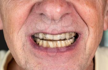 Senior caucasian man putting plastic mouth or night guard onto crooked stained teeth