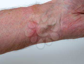 Close up of contact dermatitis or skin allergy due to wearing a leather watch strap