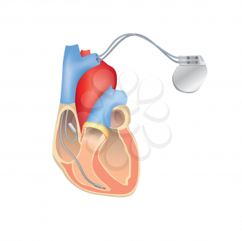 Heart pacemaker in work. Human heart anatomy cross section with working implantable cardioverter defibrillator.