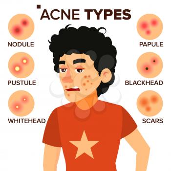 Acne Types Vector. Boy With Acne. Pimples, Wrinkles, Dry Skin, Blackheads. Isolated Flat Cartoon Illustration