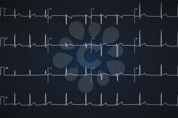 Typical human electrocardiogram, white graph on dark blue background with marks