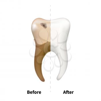 Human tooth with old sick side with caries and bright white healthy another, teeth treatment dental concept on white