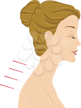 Illustration of a Woman Getting an Acupuncture Treatment