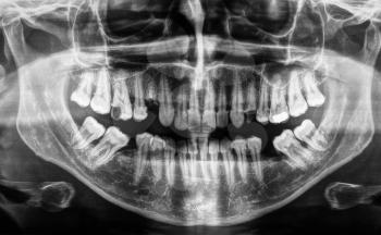 X ray of human mouth with teeth bones in black and white
