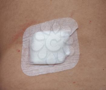 antibacterial woundpad island dressing for surgical wound care