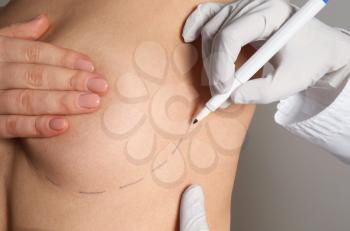Doctor drawing marks on female breast before cosmetic surgery operation against grey background, closeup�