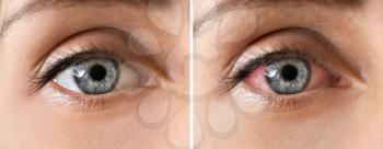Young woman without and with eye redness, closeup�