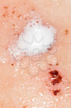 Wound on human skin in hydrogen peroxide. macro
