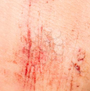 wound on the skin. close-up