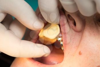 doctor makes a plastic prosthetic dentistry