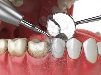 Professional teeth cleaning. Ultrasonic teeth cleaning machine delete dental calculus from human teeth. 3d illustration